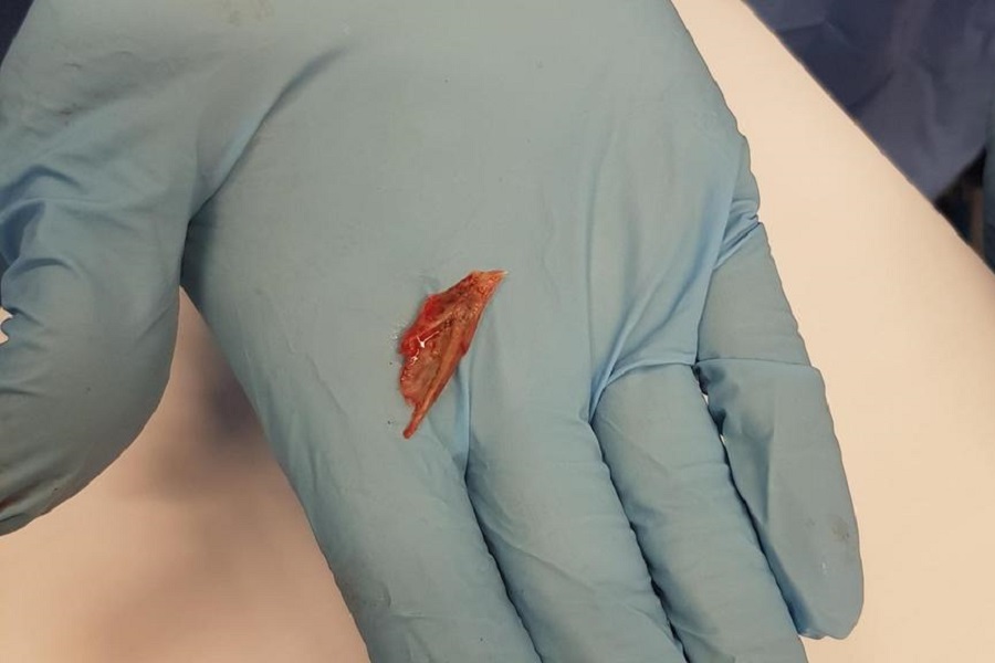 Shocked Abu Dhabi doctors find fish bone stuck in girl&#039;s lung